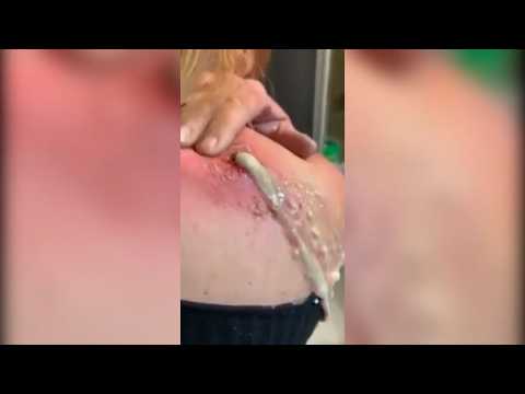 Ultimate Pimple Popping Compilation