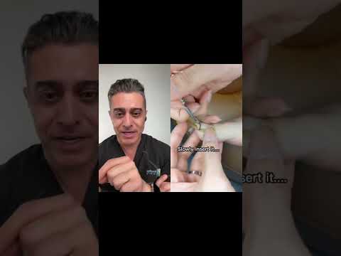 Ingrown toe-nail solution