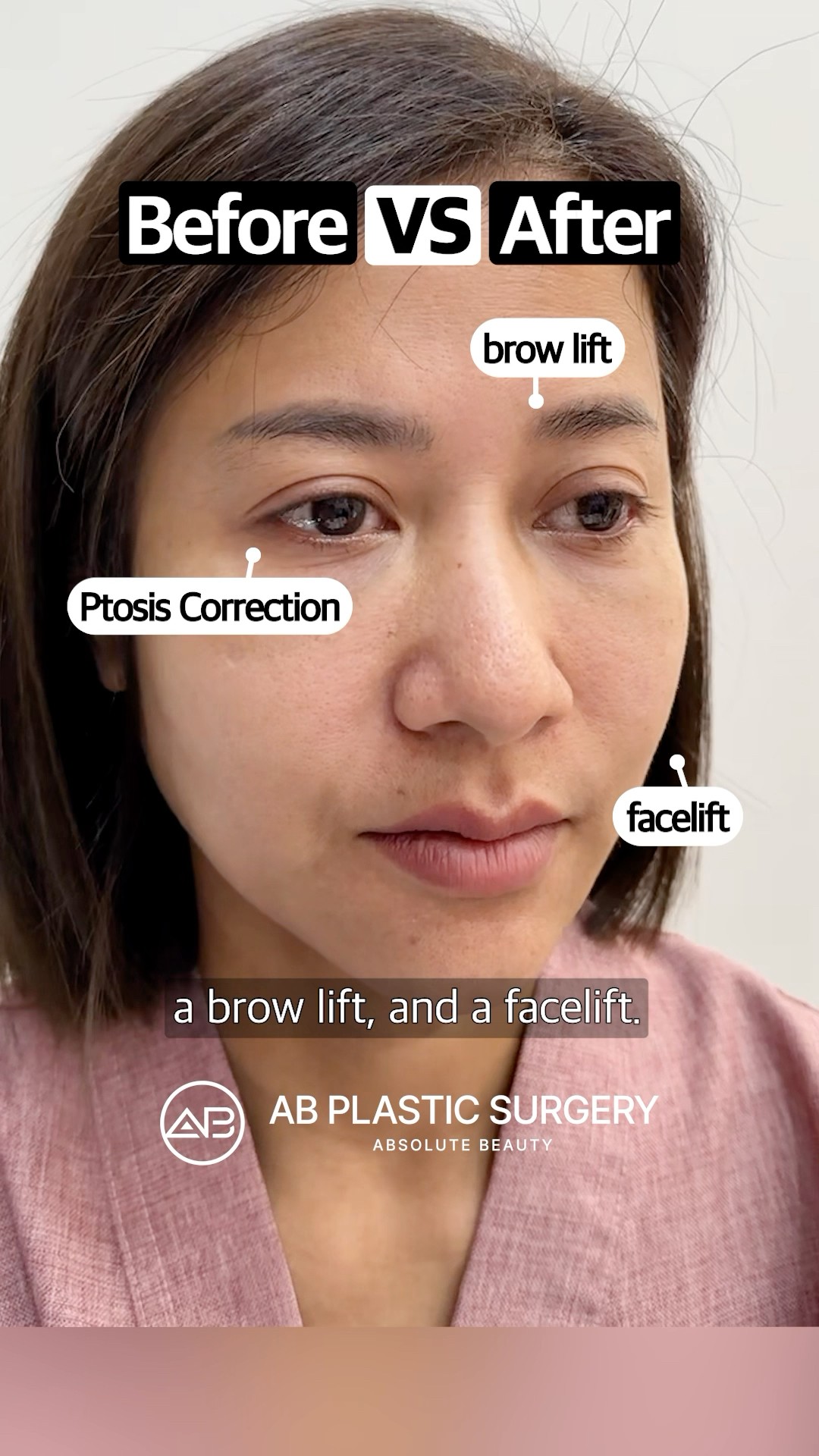 Forehead Lift Results: 8-Month Anti-Aging Transformation