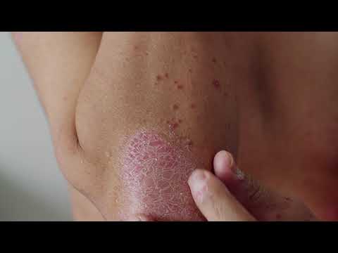 Advances in Psoriasis Treatment