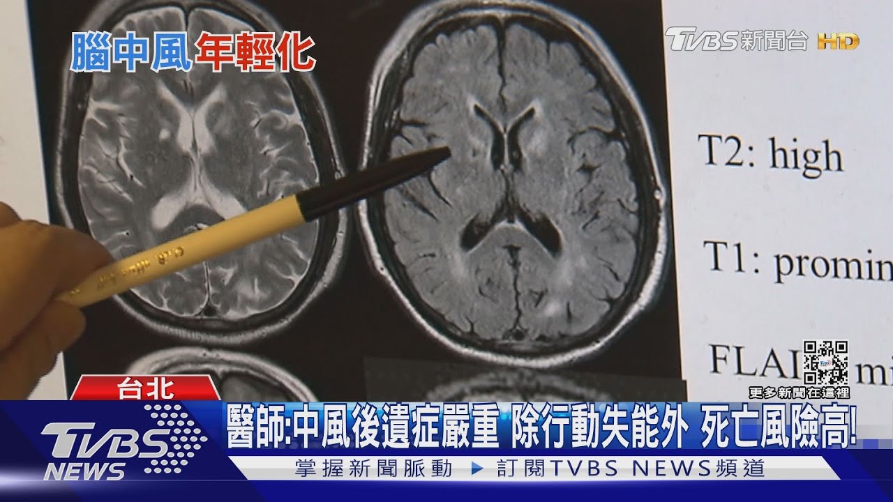 出現「這幾種症狀」...出現血栓引起腦中風... 醫師:年輕人提高警覺!