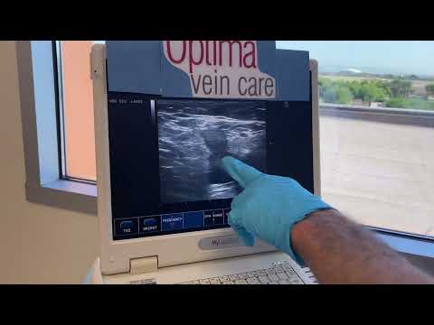 Imaging Venous Reflux of the Greater Saphenous Vein