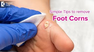 Simple tips to get rid of Foot Corn | Causes, Symptoms, Treatment-Dr. Rasya Dixit | Doctors