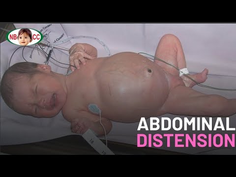 Baby with Abdominal Distension | Suppository Given & Stool Passed #FirstBreath #Neonatology