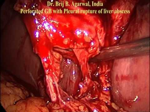 Laparoscopic Cholecystectomy Without Energised Dissection For Perforated Empyema Gall Bladder .