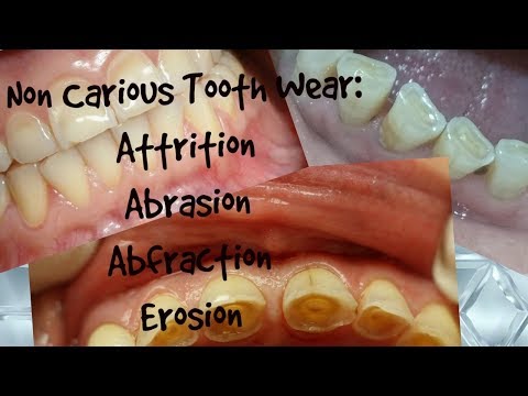 Non Carious Tooth Wear//Attrition, Abrasion, Abfraction, Erosion//Clinical Appearance, Diagnosis