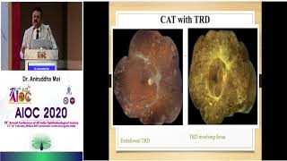 Video showing presentation of Cataract surgery in Diabetic patients