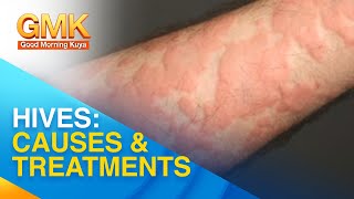 Cause and treatment for urticaria or hives | Usapang Pangkalusugan
