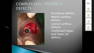 Dr. Emmanuel Muindi Nyenze - Oculoplasty  - Practical Approach to Eyelid Surgery