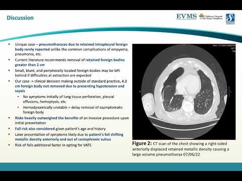 Thumbnail image of video presentation for The Risks of Retained Foreign Bodies