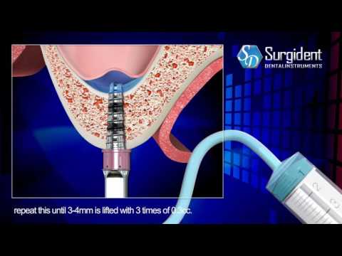 Zestaw do podnoszenia zatoki Surgident Aqua Toca