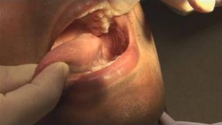 How To Check For Mouth For Cancer