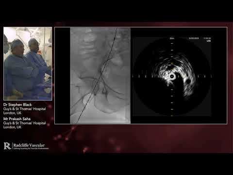 Stenting unilateral chronic disease on right hand side - Chapter 6