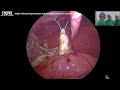 Live surgery 1 Single-incision laparoscopic cyst excision and hepaticojejunostomy part 1 - Beijing