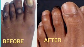 how l got rid of my corns and celluses on my toe and feet/ only 2  natural home made remedies used.