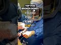 Most Common Broken Bones #fracture #orthopedics #injury #surgeonlife