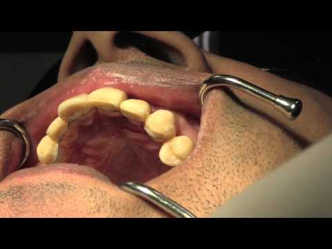 DentalVibe System for a Painless Dental Injection