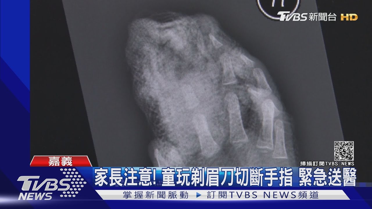 家長注意!嘉義2歲童玩剃眉刀 右手食指竟自切截斷