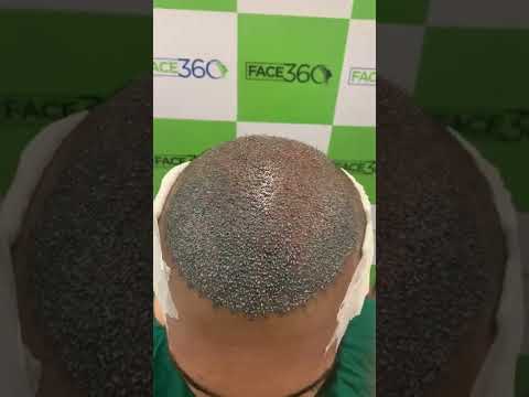 9 am to 9 pm unisex hair transplant fue