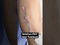 Using a laser to zap varicose veins (3D Animation)