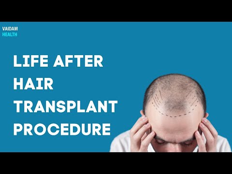 Life after Hair Transplantation