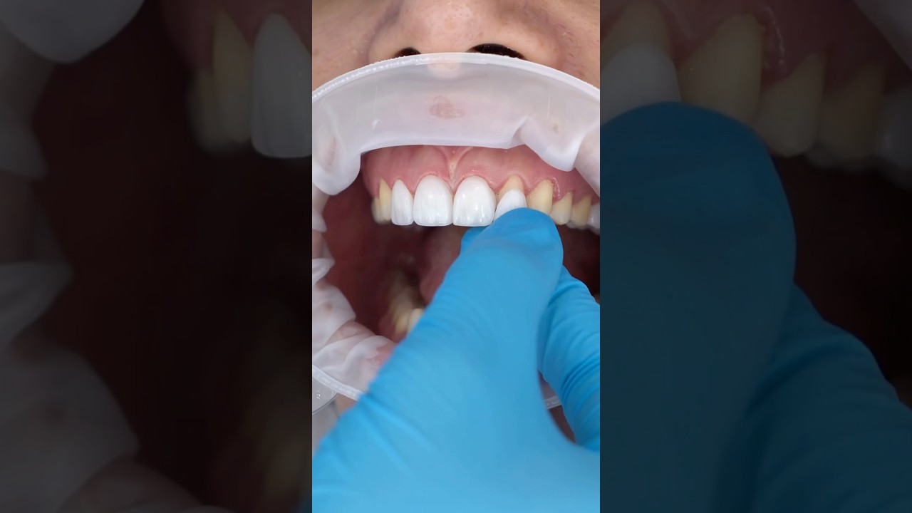 How Veneers Can Fix Your Smile