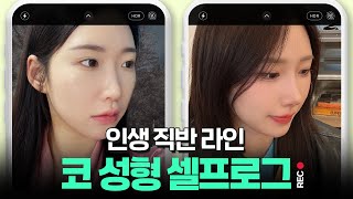 요즘 1티어 코 라인 #코성형 ㄹㅇ 찐 후기
