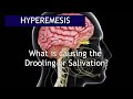 Hyperemesis What Causes The Excessive Salivation Antai Hospital