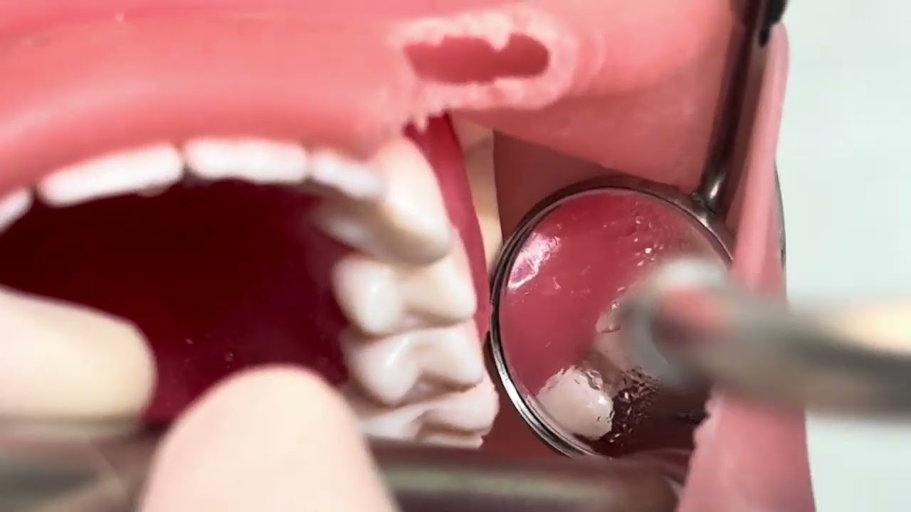 マンツーマンセミナー：左上6番支台歯形成(4/14)講師によるスライスカットしきれなかった部分を削除する方法デモンストレーション②