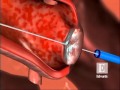 Edwards Sapien Transcatheter Heart Valve Animation
