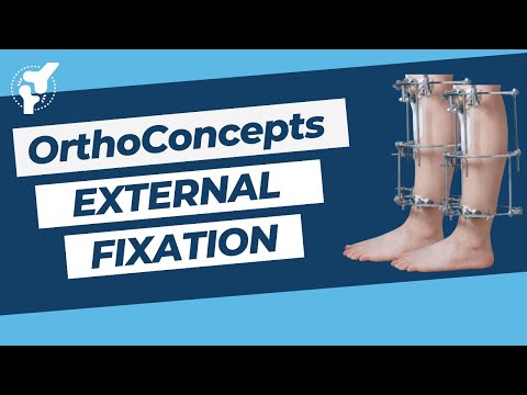 External Fixation