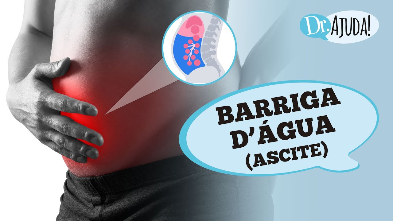 BARRIGA D’ÁGUA (ASCITE): O QUE É, CAUSA, DIAGNÓSTICO E TRATAMENTO