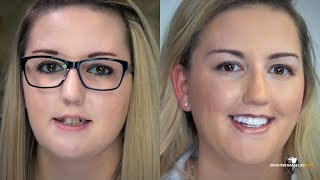 Tetracycline Teeth Stains Gone in 2 Minutes! Flawless Teeth Whitening! No Exceptions!