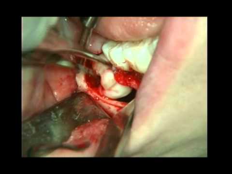 Follicular Cyst in Posterior Mandible around Impacted Third Molar