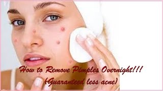 How to Remove Pimples Overnight!!! (Guaranteed less acne)