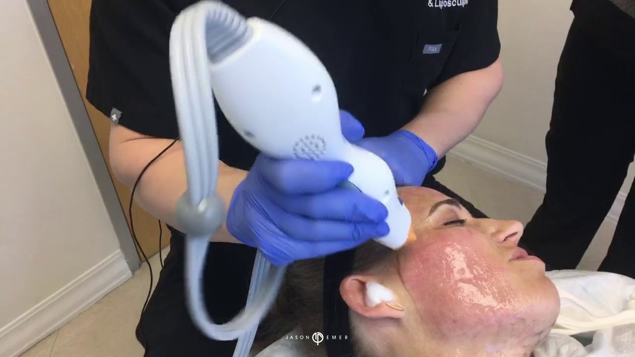 THERMAGE | SKIN TIGHTENING | NON-INVASIVE | DR. JASON EMER MD | LIVE