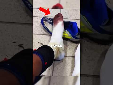 why do Yamal's feet bleed every match? #football
