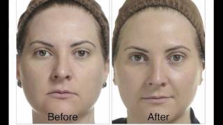 What happens after a chemical peel?