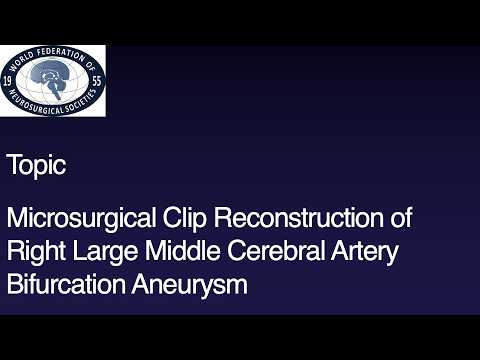 Microsurgical Clip Reconstruction of a Right Large Middle Cerebral Artery Bifurcation Aneurysm