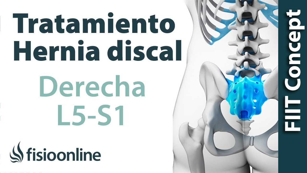 Watch Tratamiento de la hernia discal L5 y S1 derecha o quinta lumbar y sacro Now Tratamiento de la hernia discal L5 y S1 derecha o quinta lumbar y sacro