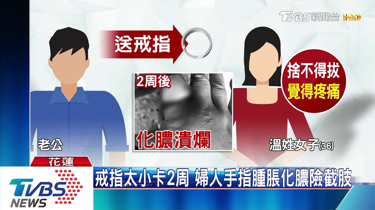 「老公送的」捨不得摘 「戒指太緊」婦手指化膿