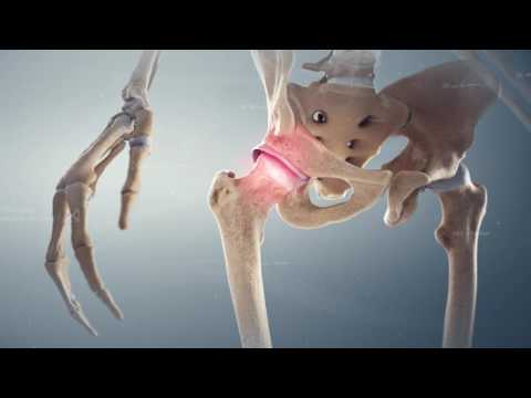 Röntgen Anzeichen von Hüft-Arthrose Was bei Osteochondrose der lumbosakralen zu tun