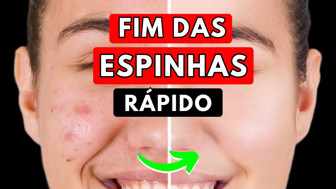 DESCUBRA 6 SUPLEMENTOS PODEROSOS para ACABAR RAPIDAMENTE COM ESPINHAS E CRAVOS