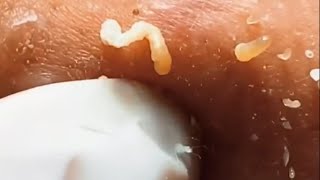 SATISFYING AND RELAXING PIMPLE POP COMPILATION | PART 15