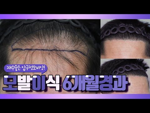 타병원 모발이식,재수술 6개월경과영상! (20대 중반 남성, 비절개 3500모)