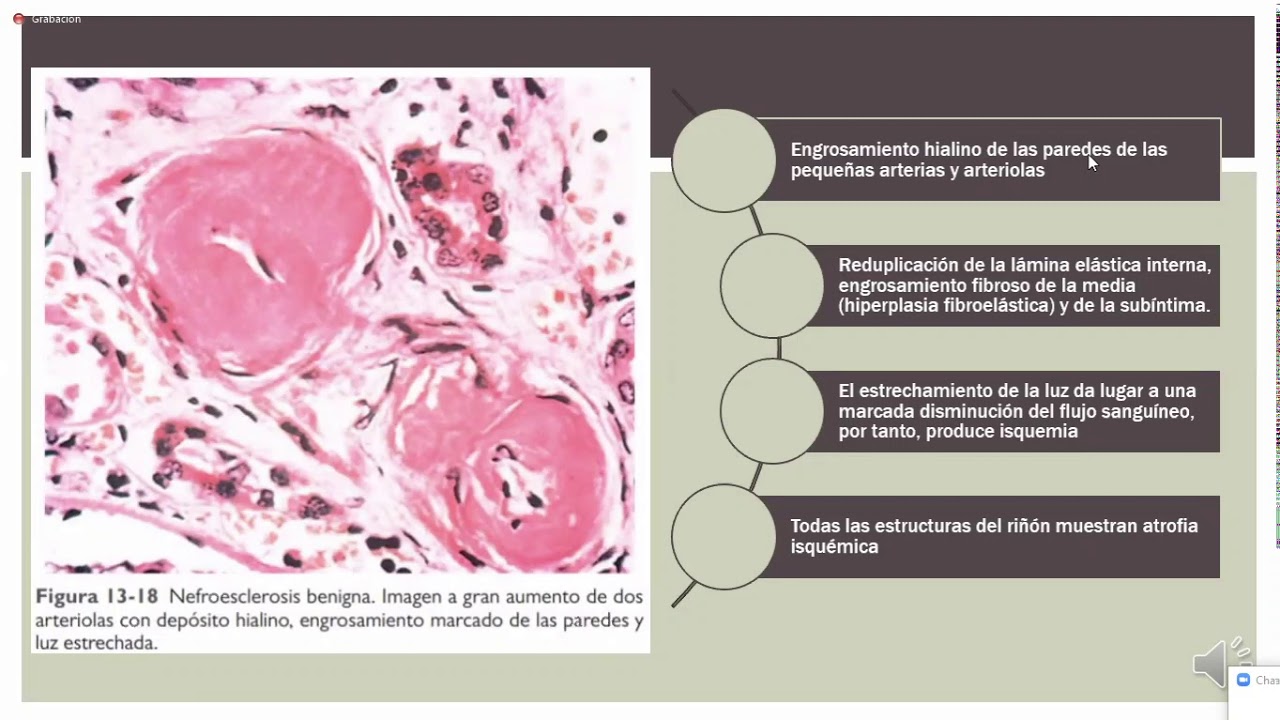 Putar video Patología Renal II - Patología II PRA sekarang Patología Renal II - Patología II PRA