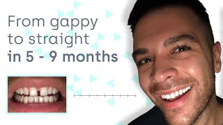 How to close teeth gaps safely and invisibly at home