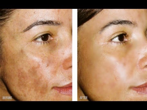 Come la maggior parte per togliere posti di pigmentary su una faccia Togliere labbronzatura di lentiggini