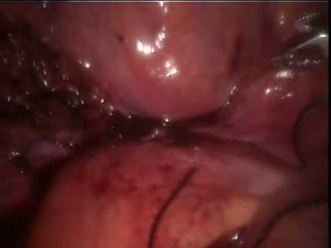 Partial Urinary Bladder Endoscopy With Bladder Diverticulum Removal (Robotically-Assisted And Laparoscopic) (3/3)