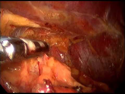 Right Adrenal Gland Adenoma- Laparoscopic Excision